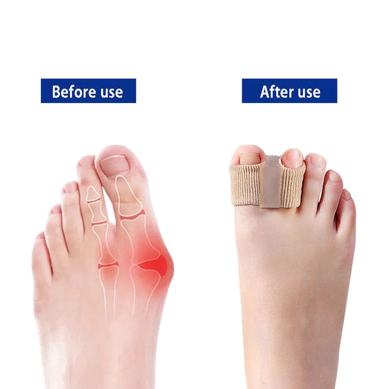 Premium Elastic Toe Separators – Comfortable Pain Relief & Alignment